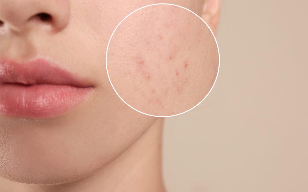 Skin Health And Anti-Acne Effects of Taxifolin Skin Health And Anti-Acne Effects of Taxifolin